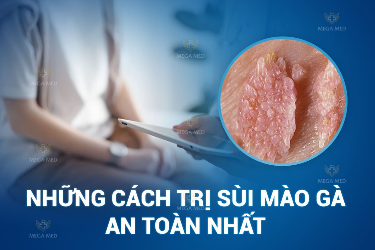 những cách điều trị sùi mào gà 